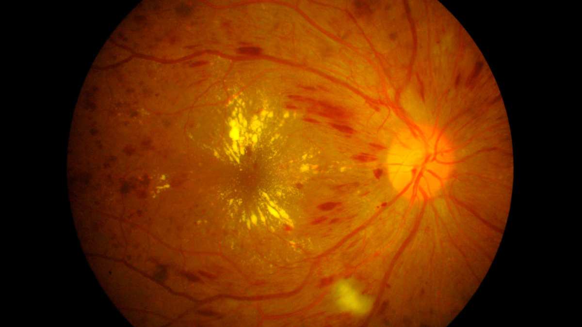 Enfermedades en ojos, edema macular