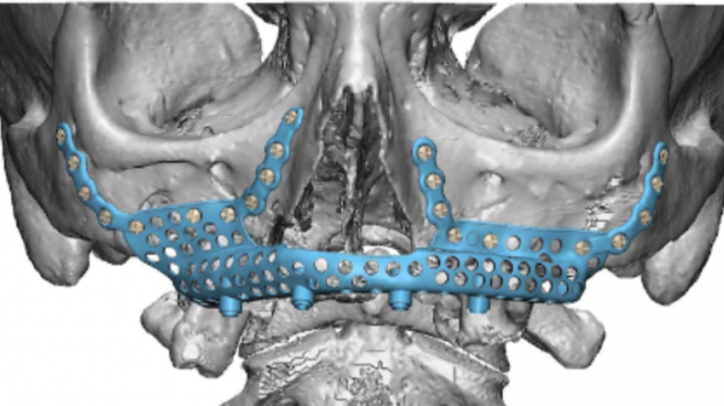 Prótesis de titanio: una de las soluciones más eficaces para reconstruir la atrofia maxilar
