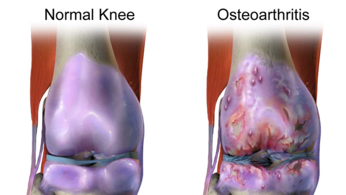 Alimentos contra la osteoartritis