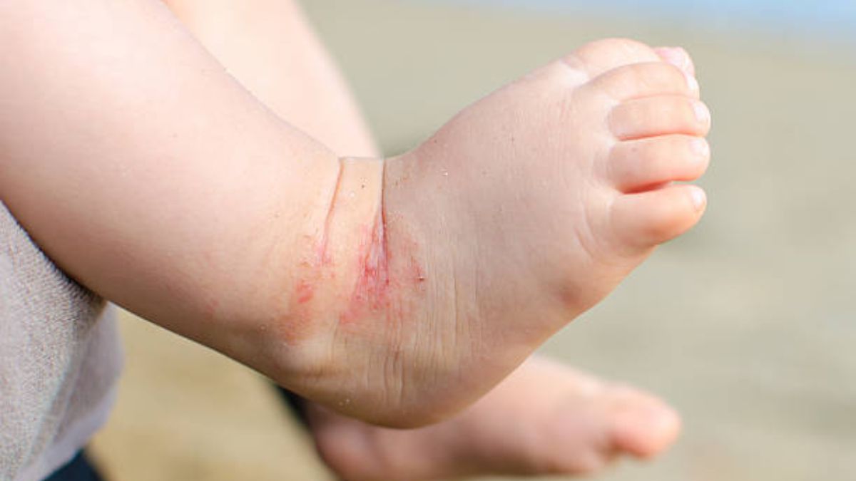 Qué es y cómo se debe tratar la piel atópica en los bebés