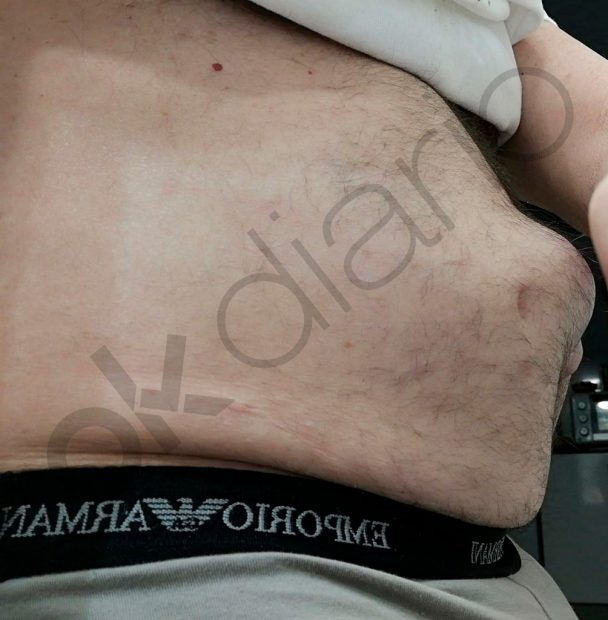 Así estaba la hernia antes de la agresión.