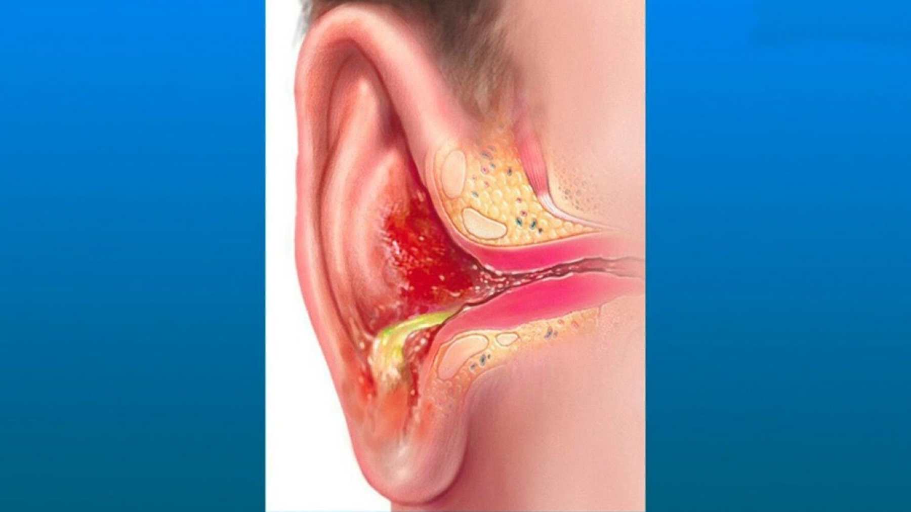 Causas de sarpullidos y secreciones de oído