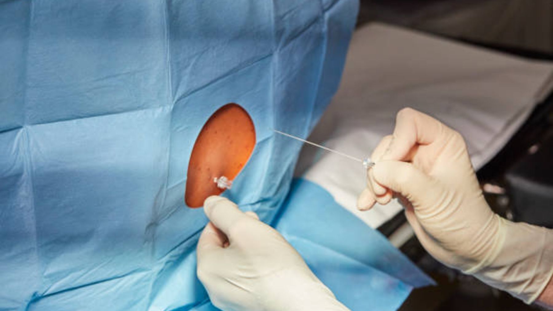 Cuáles son los pros y contras de la epidural