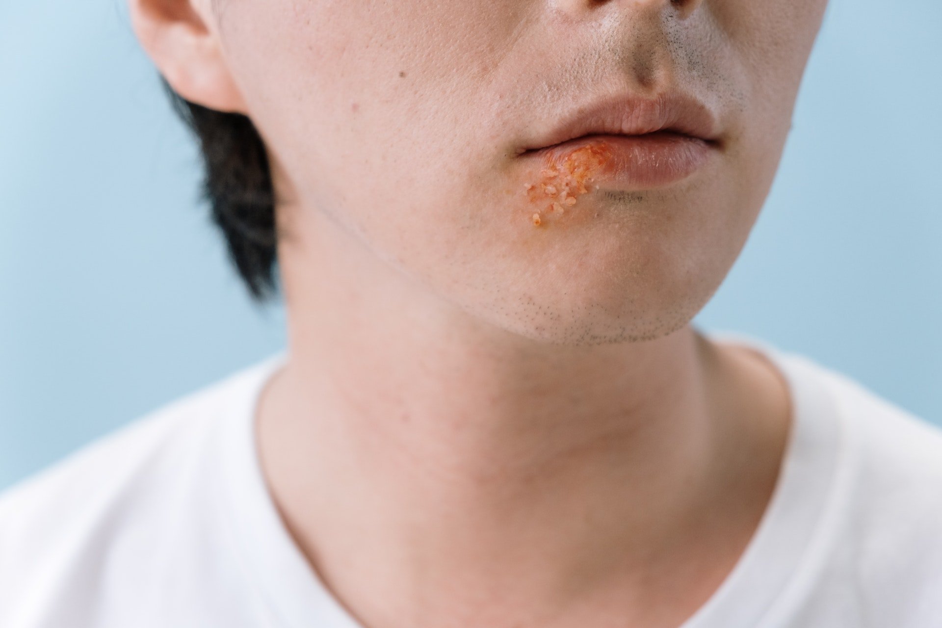 Toma nota de los tratamientos para reducir el herpes labial