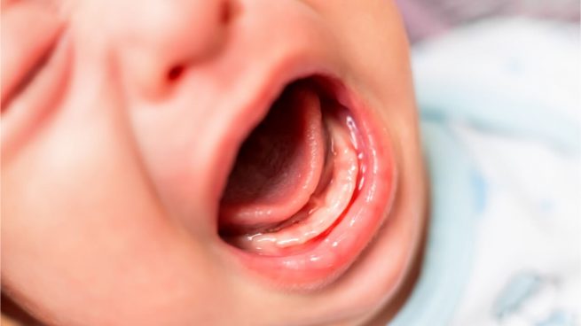 candidiasis oral bebés