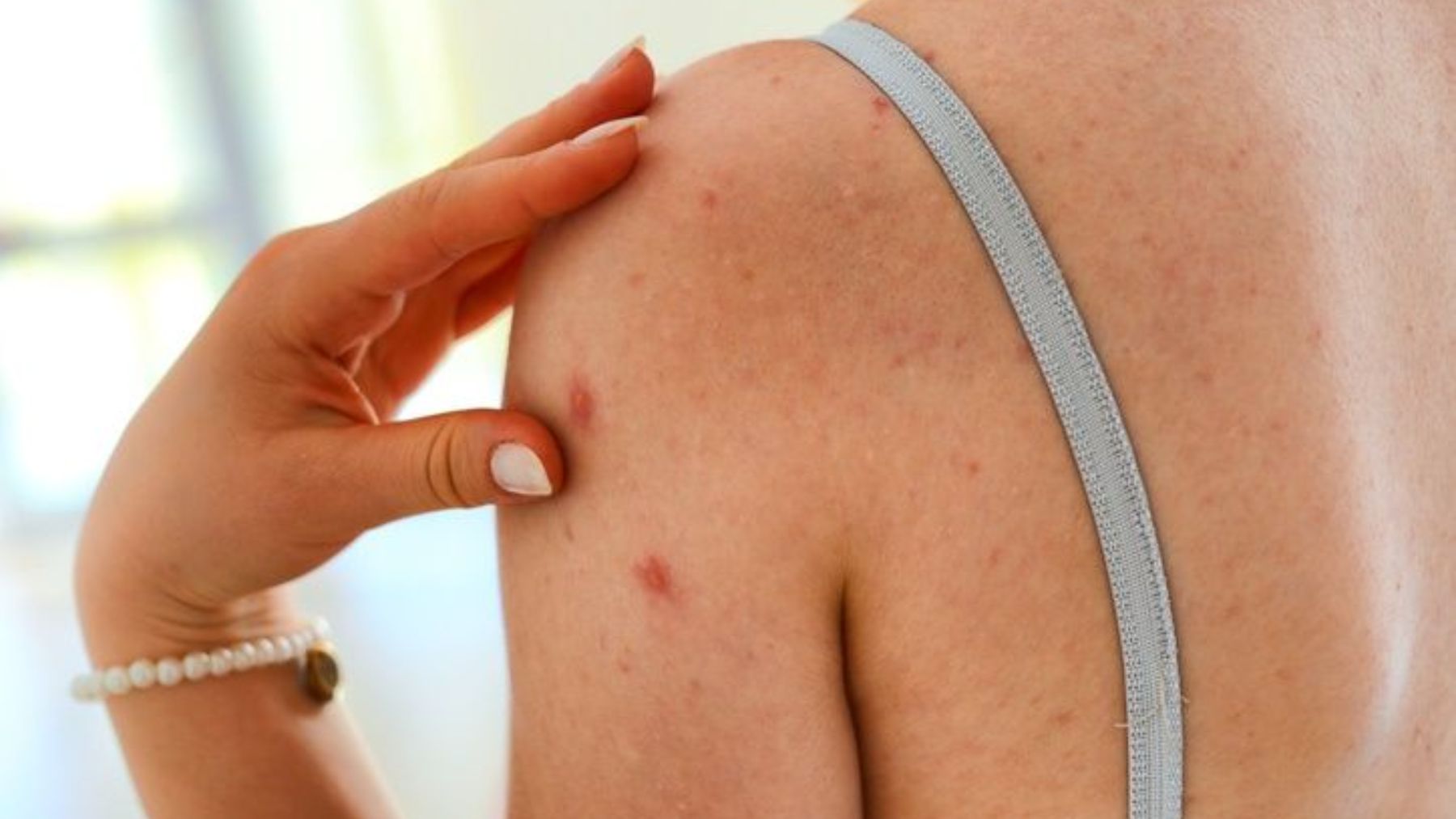 Cómo tratar de manera eficaz el acné corporal