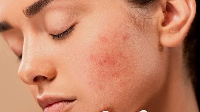 Los malos hábitos que debes dejar de hacer si no quieres tener acné