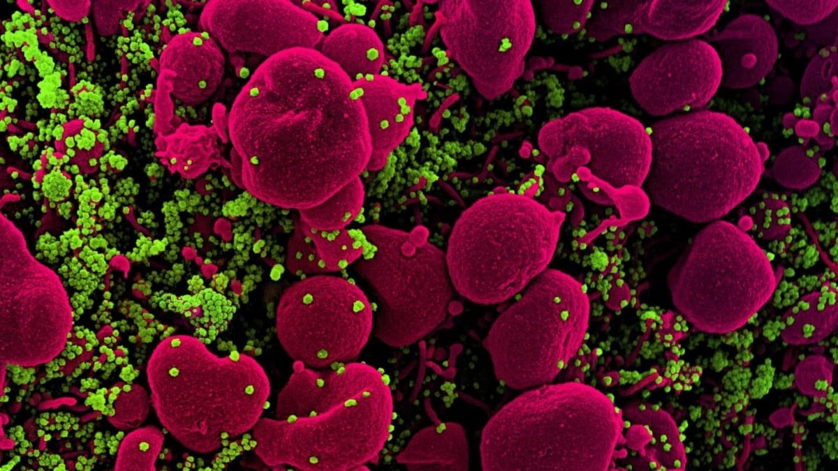 Micrografía electrónica de barrido coloreada de una célula apoptótica (rosa) muy infectada.