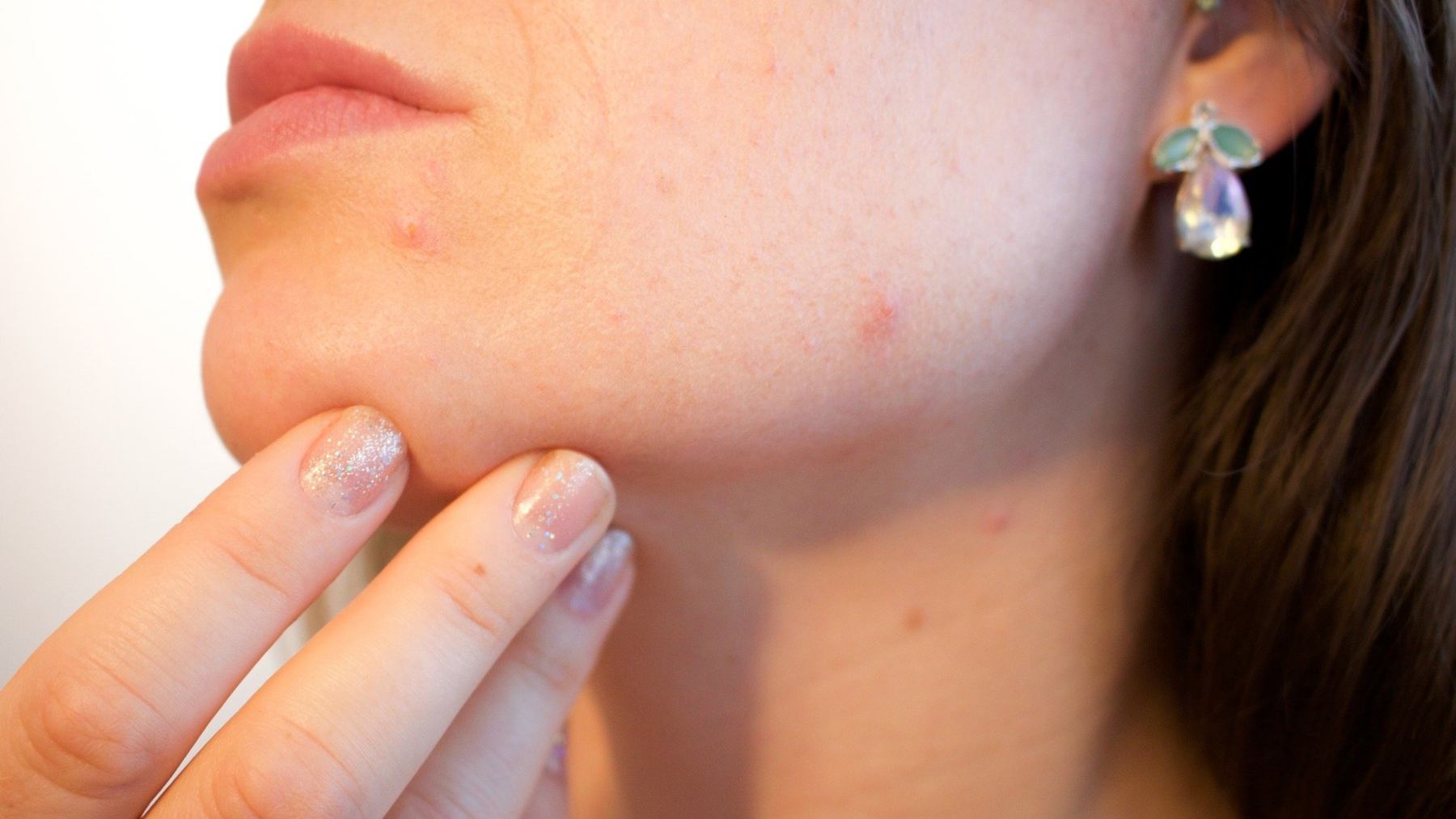 El acné en la cara suele tratarse con antibióticos tópicos.