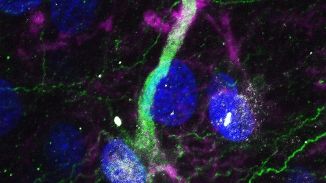 Las enfermedades neurodegenerativas atacan a las células madre del cerebro e impiden generar nuevas neuronas