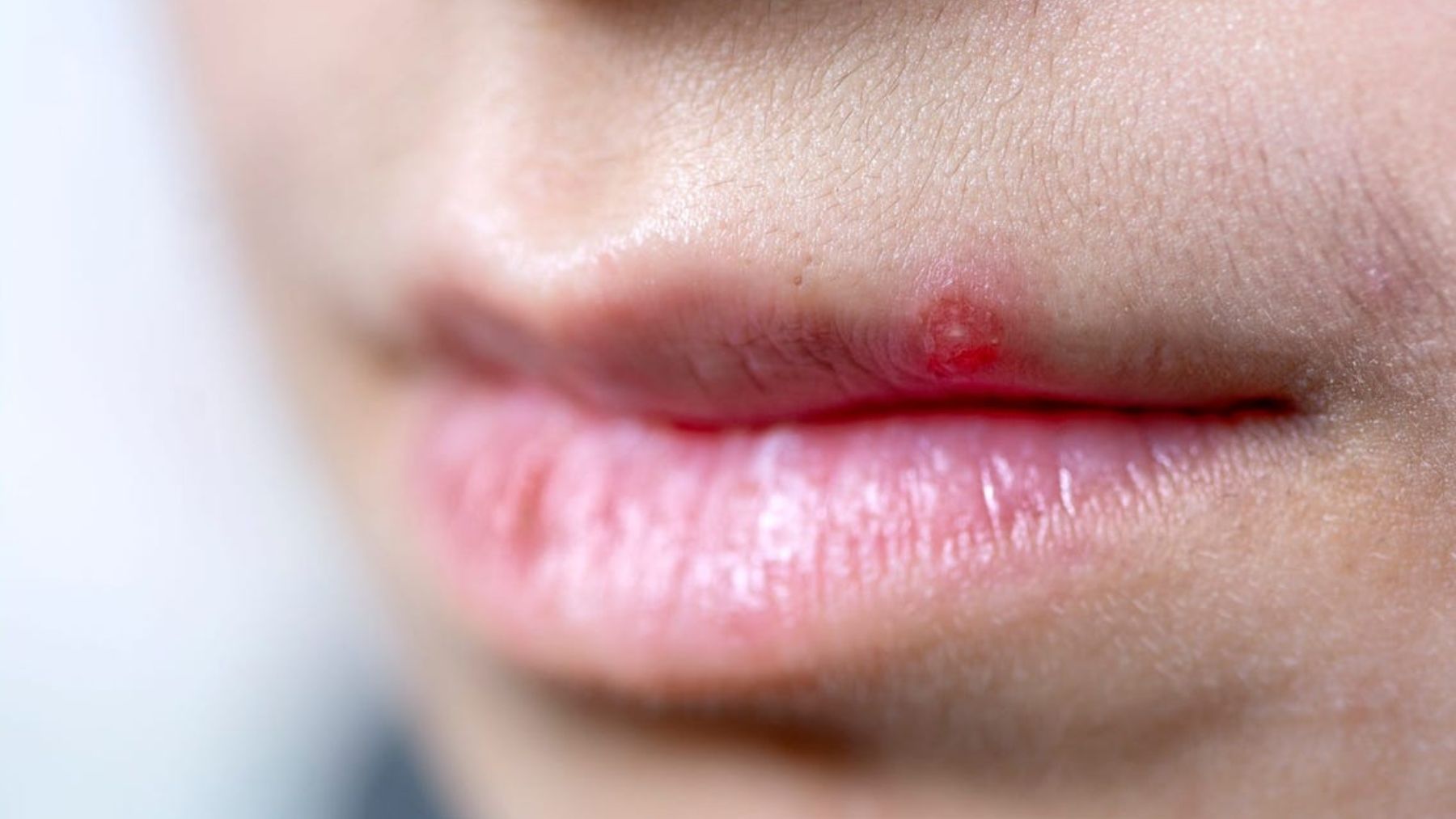 Descubre de qué modo puedes evitar que te aparezcan espinillas en los labios
