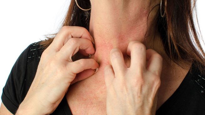 Seis hábitos dañinos para personas con dermatitis
