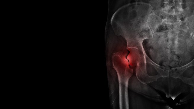 La fractura de cadera afecta más a mujeres ¿Cuál es el motivo?