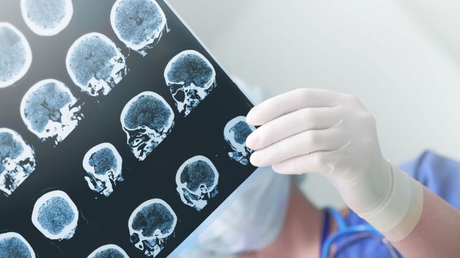 Detección precoz del Alzheimer a través de la investigación del líquido cefalorraquídeo