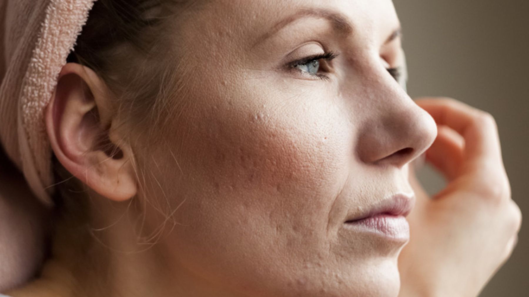 Cuál es la causa y cómo tratar el acné tras el embarazo