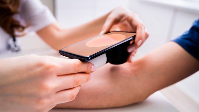 La autoexploración con el teléfono móvil facilita la detección precoz del melanoma