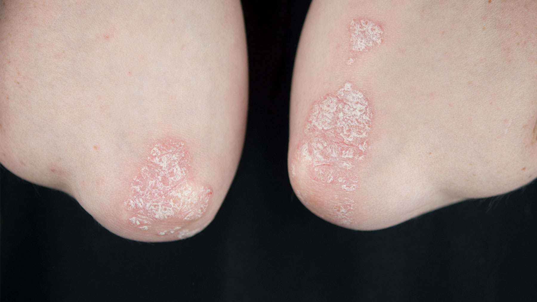 La psoriasis es una enfermedad inflamatoria crónica no contagiosa causada por una alteración del sistema inmune.