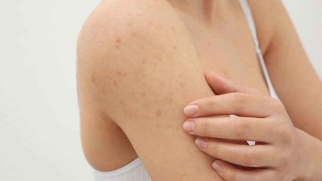Casos Sarna: Los dermatólogos advierten de que los tratamientos contra la  sarna están perdiendo eficacia