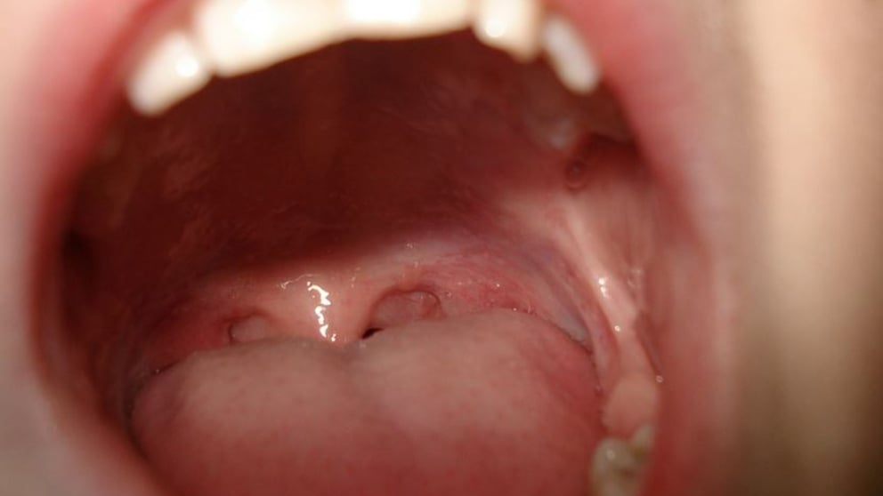 Cáncer de cabeza y cuello: qué es y qué síntomas provoca