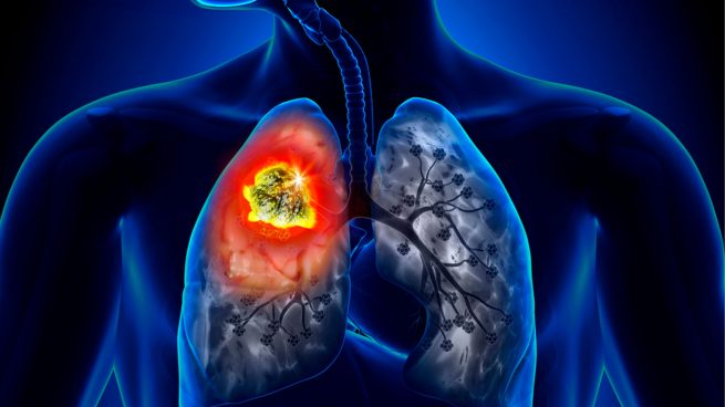 Nuevos medicamentos para el cáncer de pulmón de células pequeñas