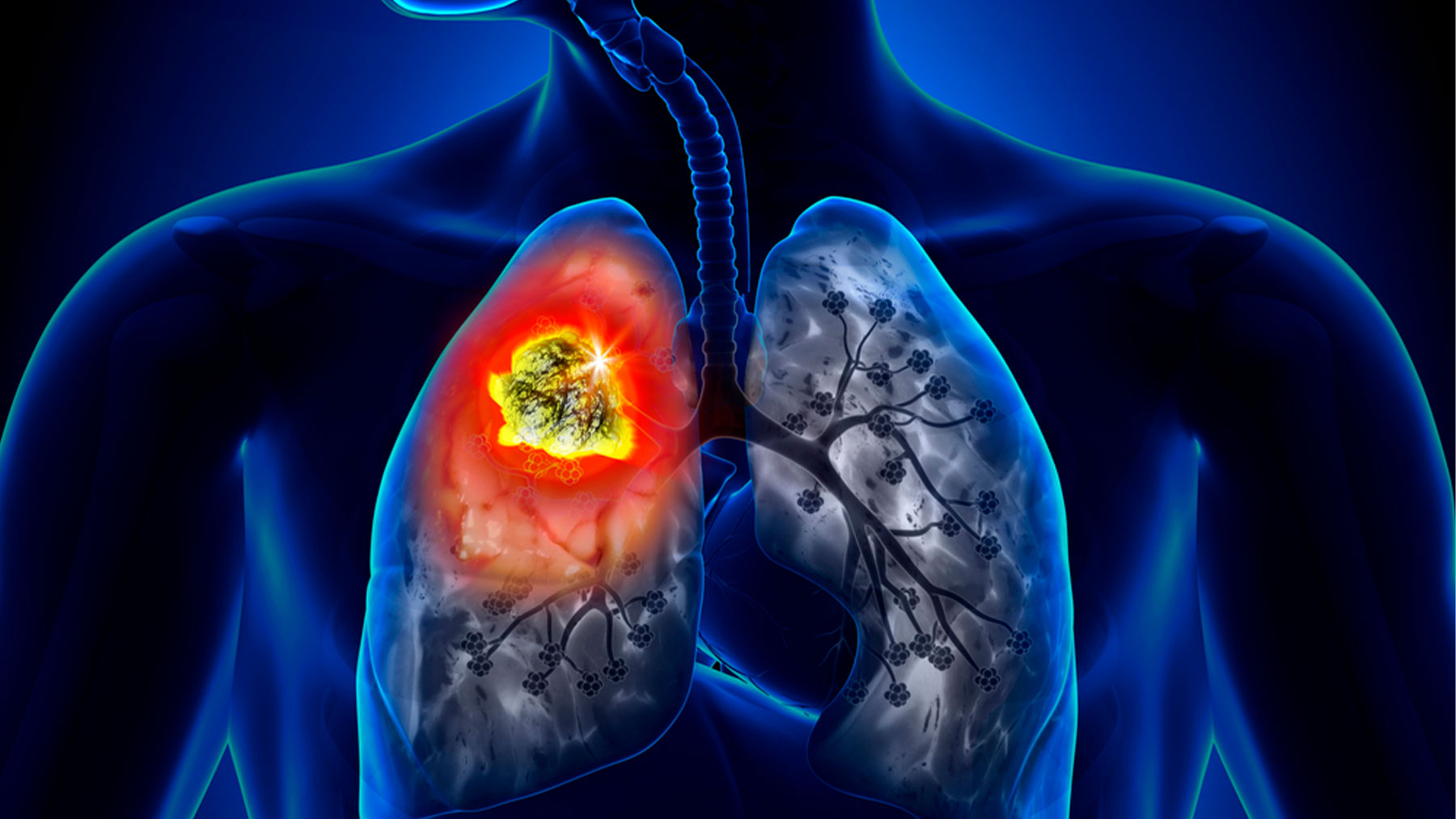 Nuevos fármacos para el cáncer de pulmón.