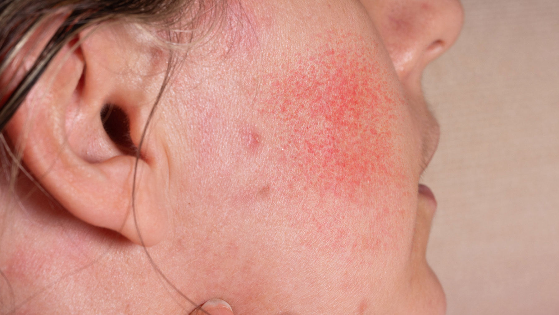 En muchas ocasiones hay casos que comienzan como acné y evolucionan hacia rosácea.