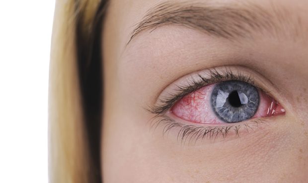 Los principales síntomas que podemos tener en un derrame ocular