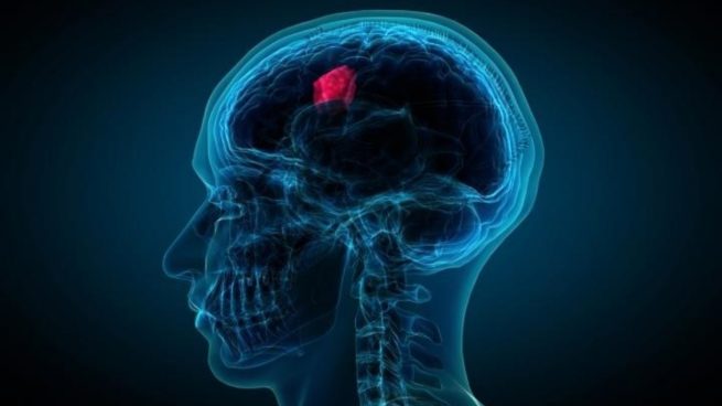 Los tumores cerebrales mortales serán tratados con un nuevo método
