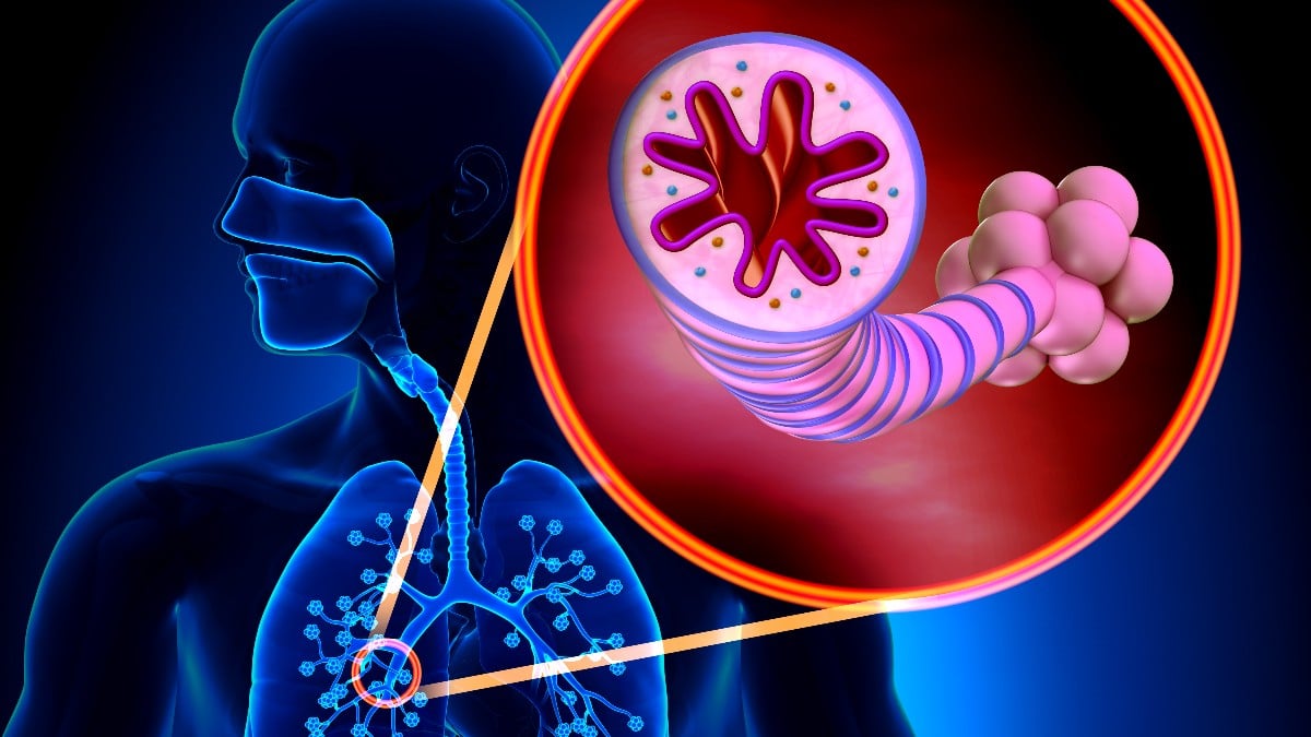 Asma, inflamación respiratoria crónica.