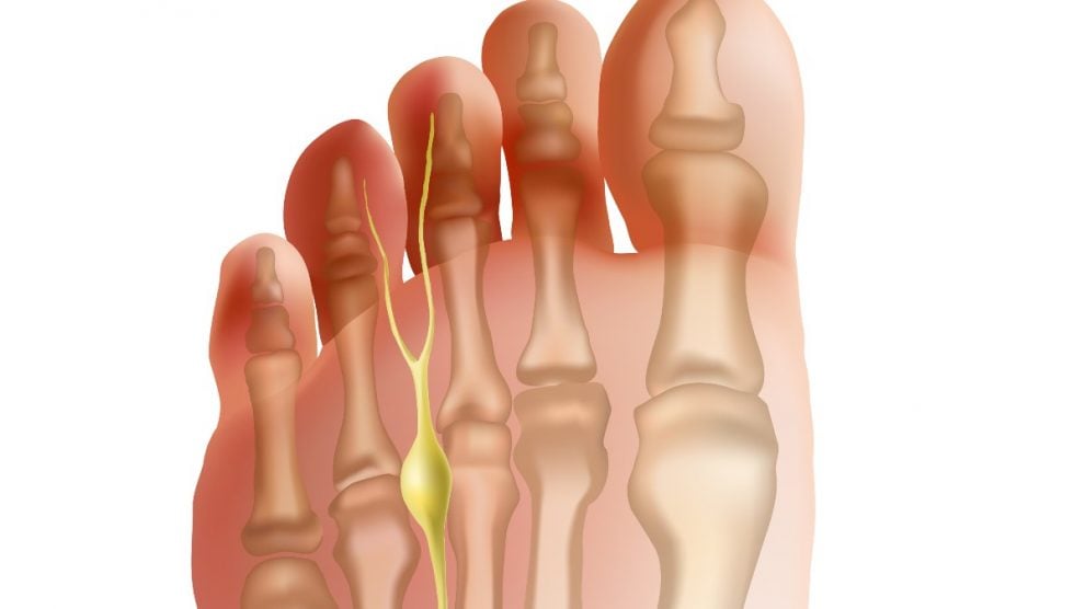 La Reina Letizia padece el neuroma de Morton en su pie izquierdo