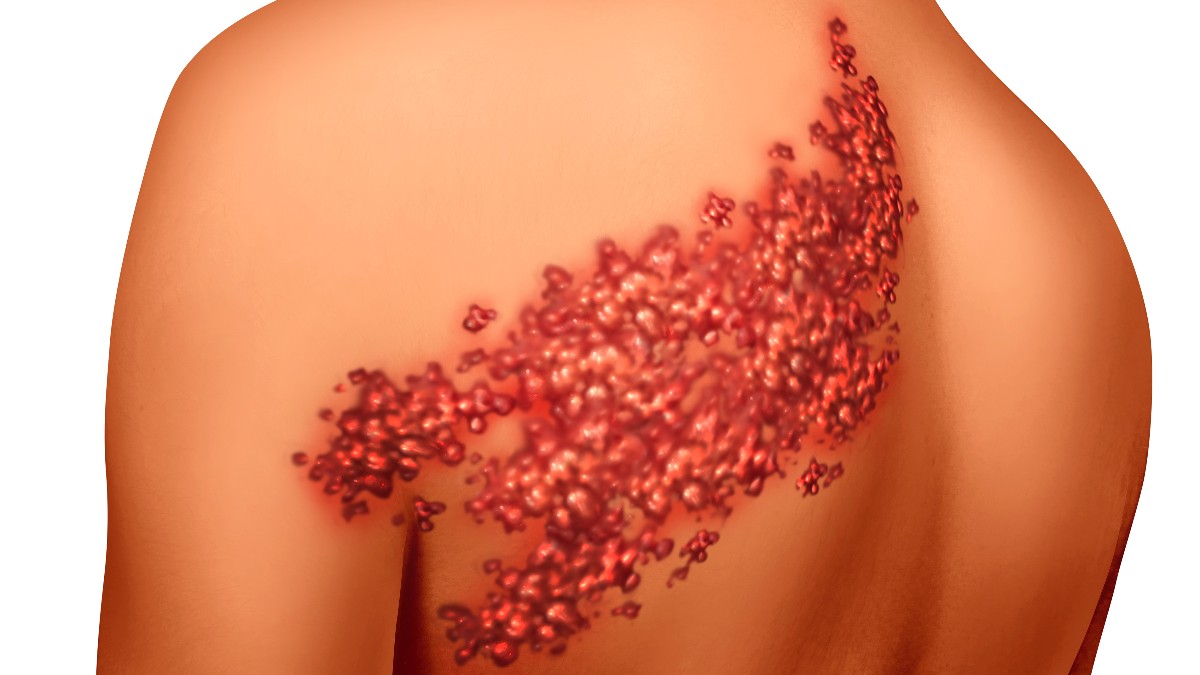 Herpes Zóster.