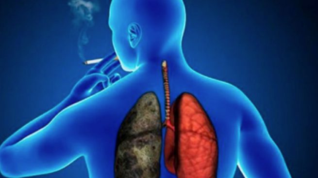 EPOC cáncer de pulmón