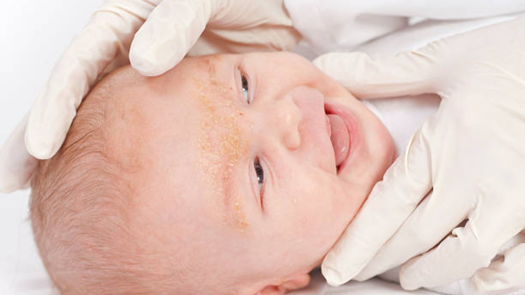 Cómo cuidar la costra láctea del bebé