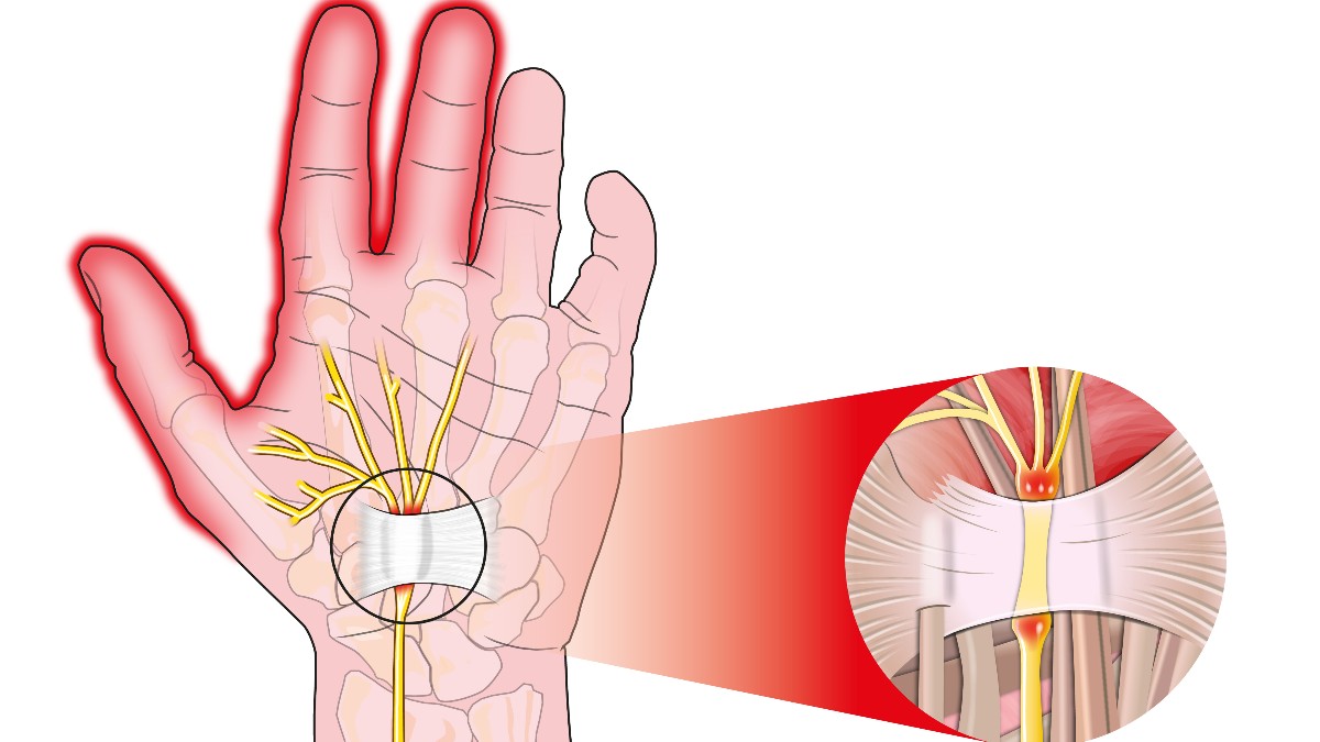 Síndrome del túnel carpiano.