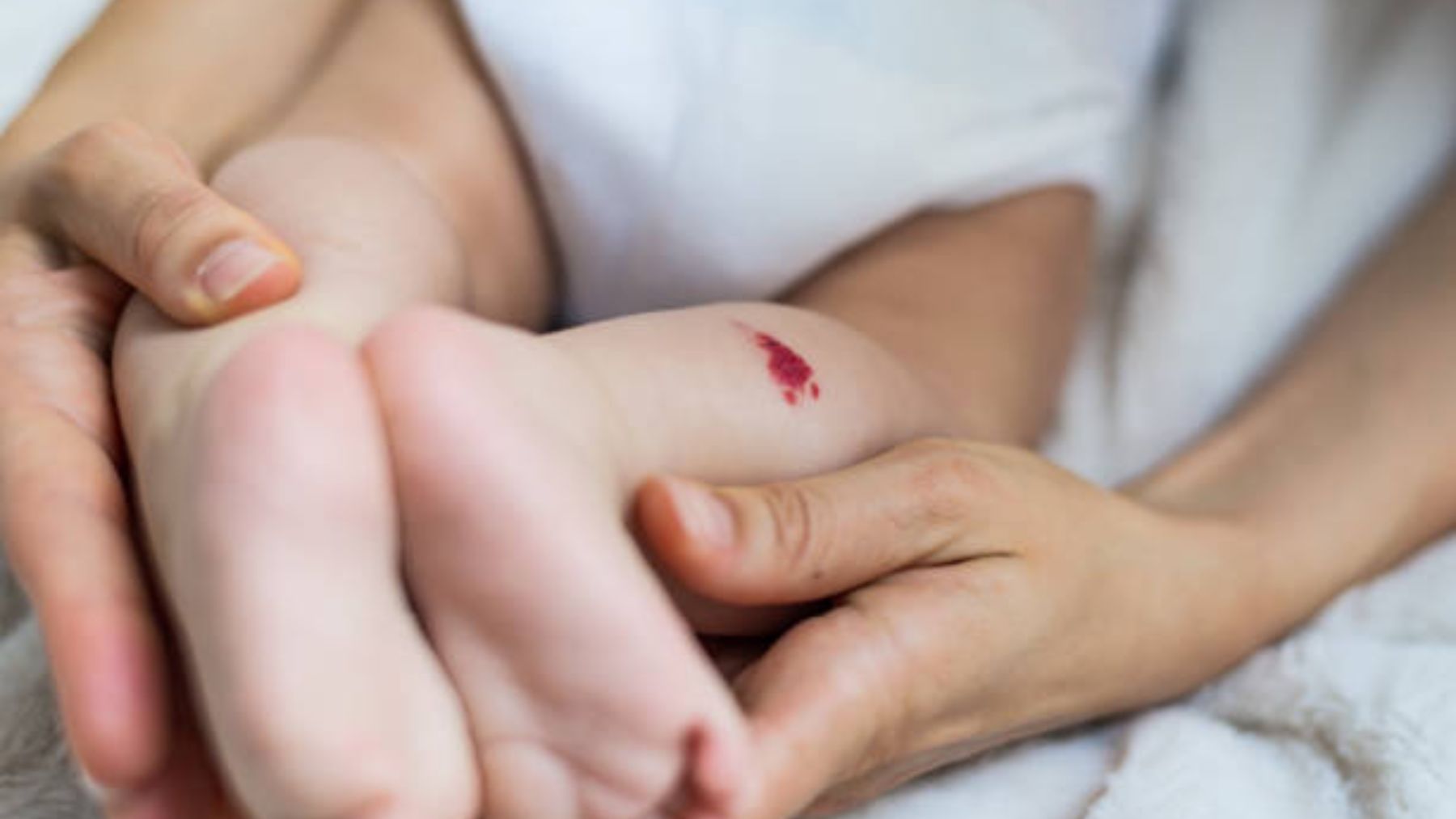 Descubre qué son los angiomas en los bebés y cuándo preocuparse