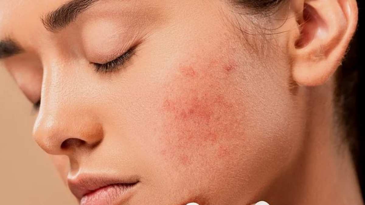 Así son los diversos tipos de cicatrices por acné según los expertos