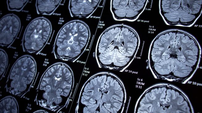 Epilepsia: la importancia de detectarla a tiempo