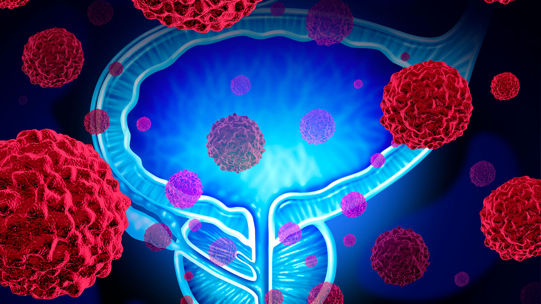 En la actualidad, la inmensa mayoría de casos de cáncer de próstata se diagnostica en estadios iniciales.