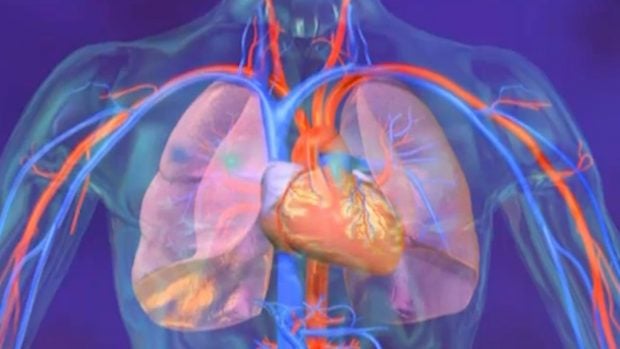 hipertensión pulmonar