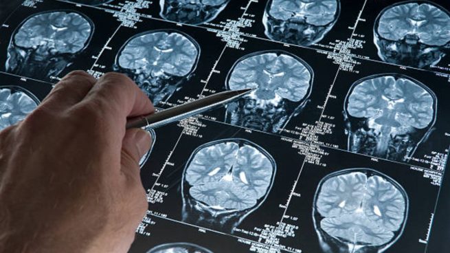 Ponen en duda los resultados de nuevos medicamentos para el Alzheimer.