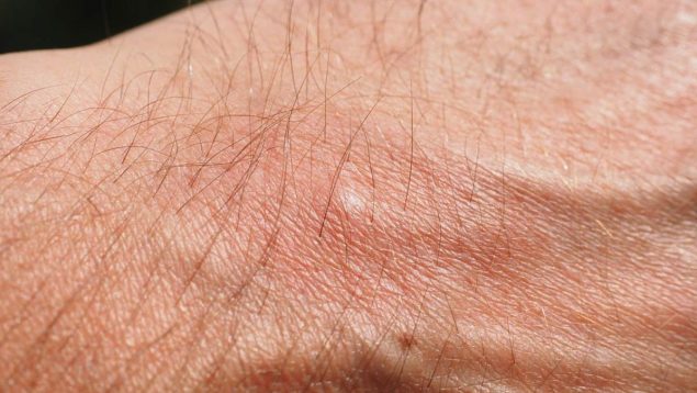 ¿Qué es el síndrome de las picaduras de mosquitos? Te lo contamos