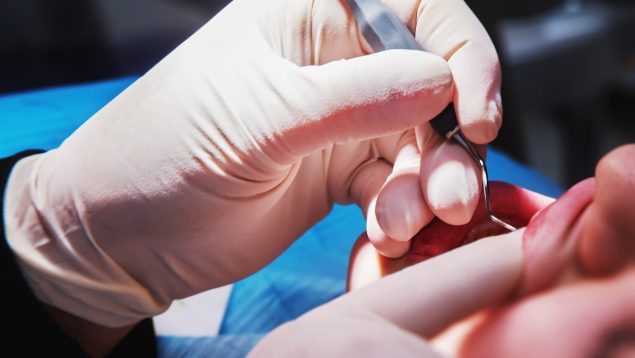 periodontitis