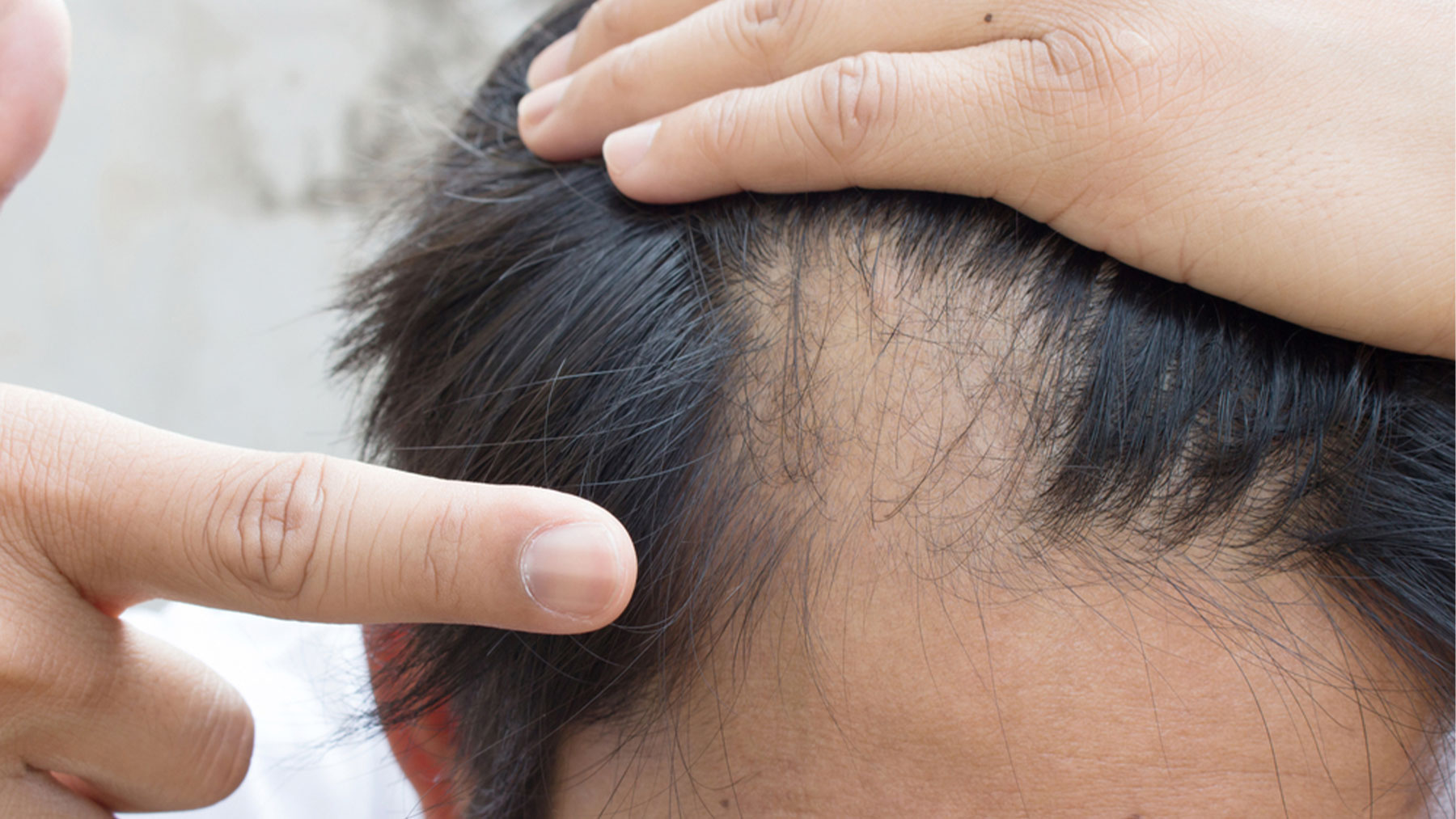 La alopecia areata es la segunda causa más frecuente de caída del cabello.