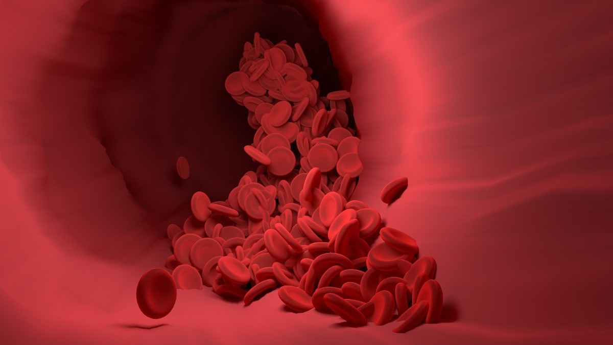 La hemofilia es una enfermedad de coagulación de la sangre.