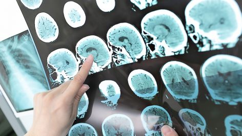 Un doctor comprueba una imagen cerebral.