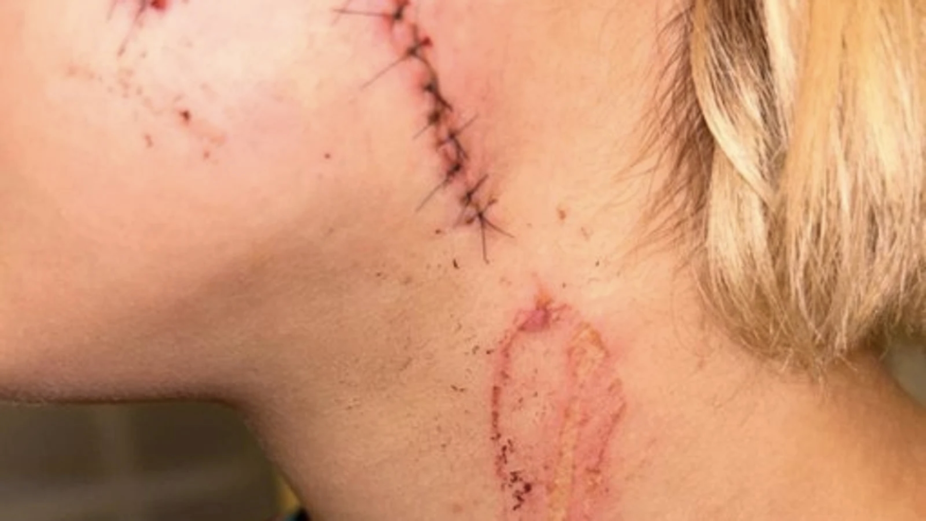 La joven agredida quedó con una enorme cicatriz en rostro y cuello.