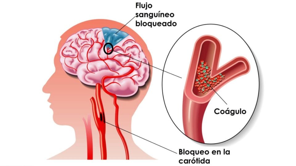 Dr. Pedro Navia: Los avances en el tratamiento de los ictus permiten extraer el 90% de los trombos