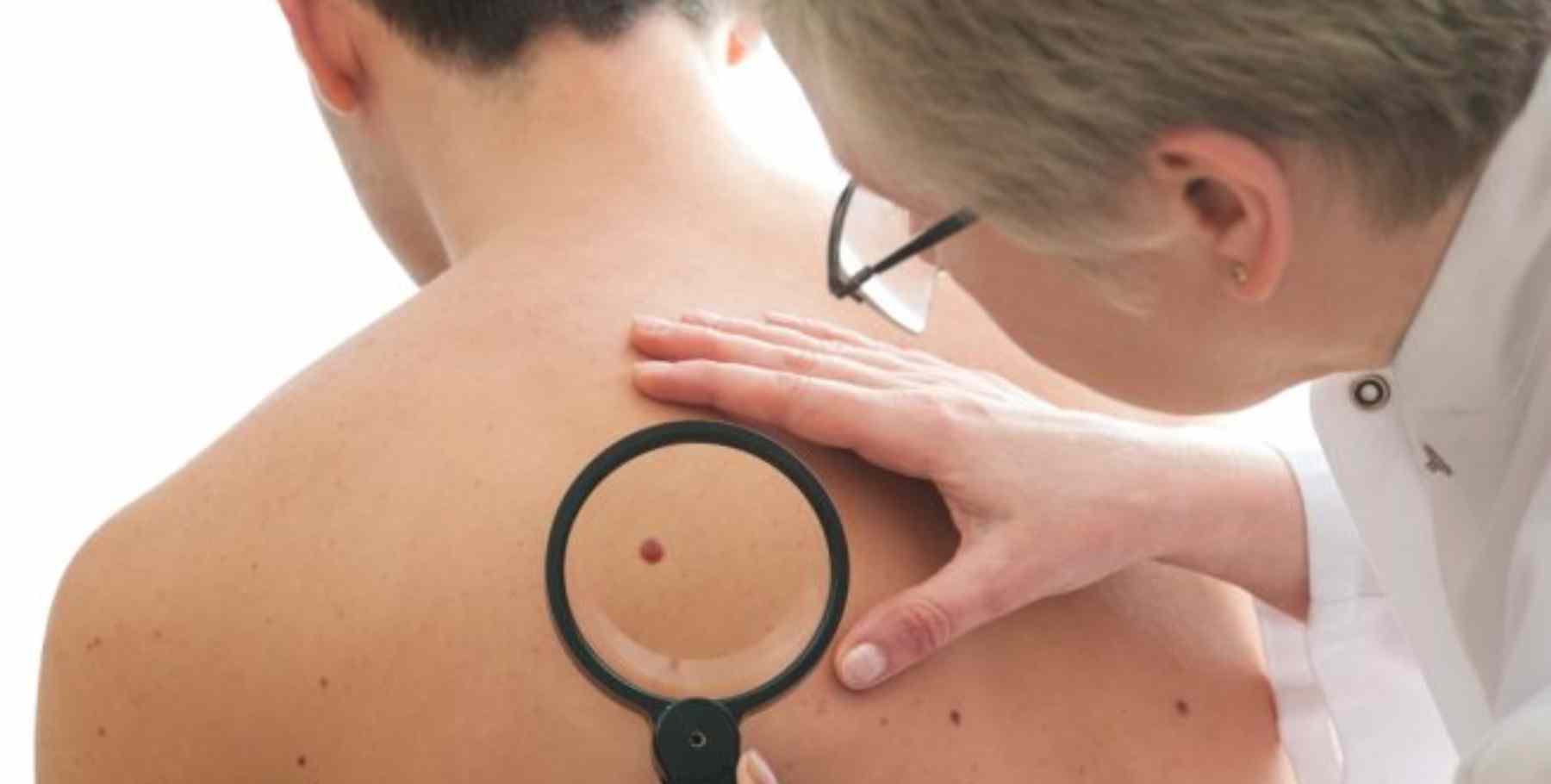 Qué son los puntos rojos en la piel y por qué salen: ¿son peligrosos?