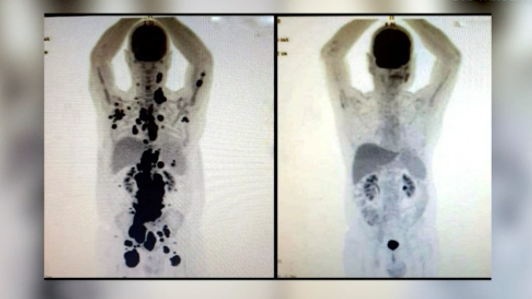 Impresionante imagen de un hombre que venció el cáncer con la terapia CART-T.