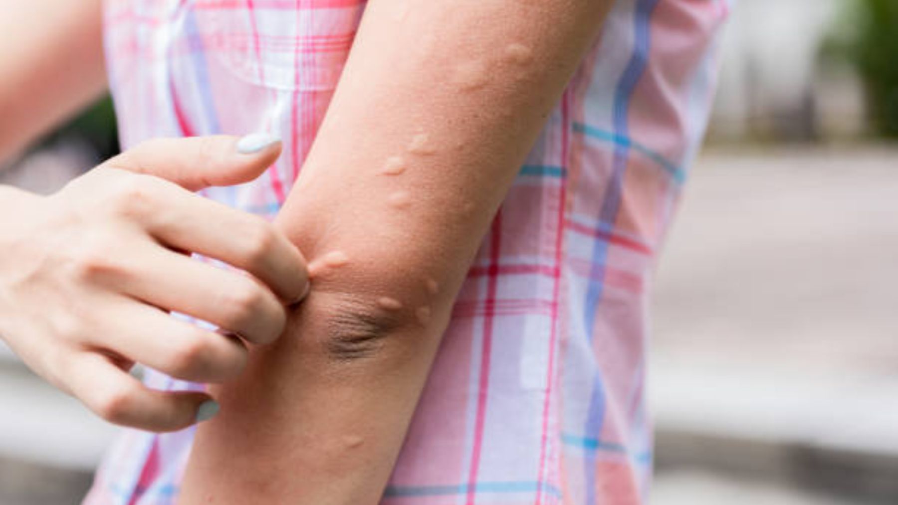 Lo que dice la ciencia sobre el picor de las picaduras de mosquito
